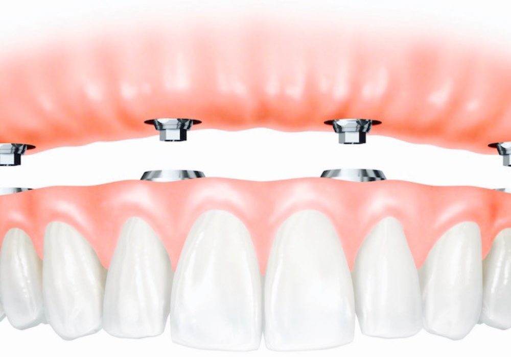 Fixed-Denture-Implants-Vancouver