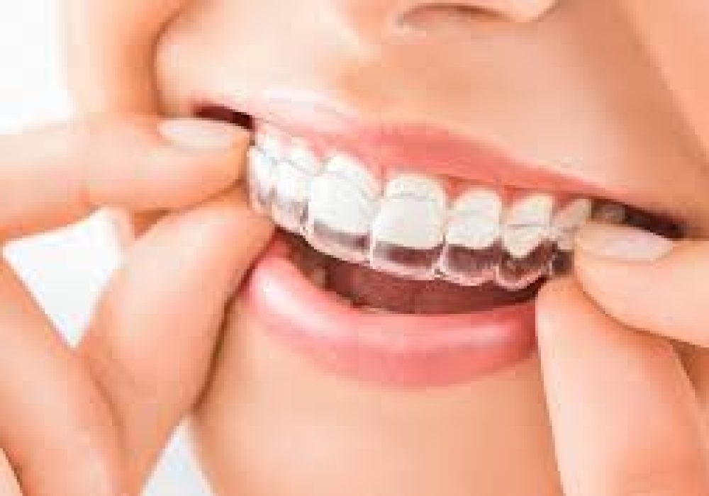 aligner