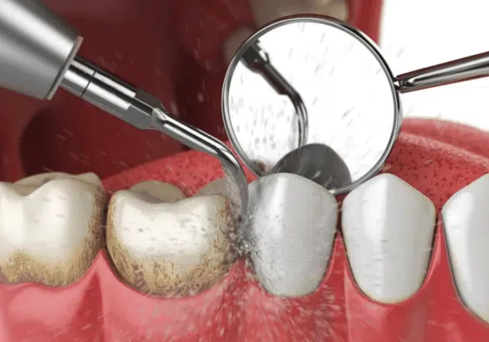 what-is-dental-scaling-2-antalya-smile-designs